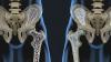 Kāpēc kalcija nedrīkst osteoporozes? Visu patiesību par kalciju, un to, kā saglabāt kaulu audu labā formā