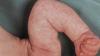 "Marmora" āda zīdaiņiem: norma vai patoloģija? Neirologs atbild
