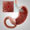 Gastrīts, vai erozija kuņģa: galvenie simptomi, ārstēšana, uzturs