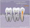 Kā atrast un ārstēt zobu kanālus Lumidentā