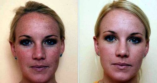 Carbon pīlings. Fotogrāfijas pirms un pēc. Pacients ir taukainas ādas tips.
