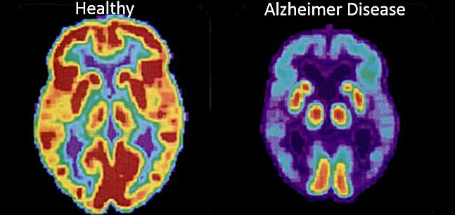Pirmais attēls - smadzenes veselīgu personas, otrā - Alcheimera slimība 