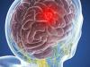 Smadzeņu audzējs: 5 simptomi, ko nevar ignorēt