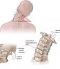 4 pamata vingrinājumi kakla mugurkaula palīdzēs aizmirst par sāpēm un osteohondrozi!