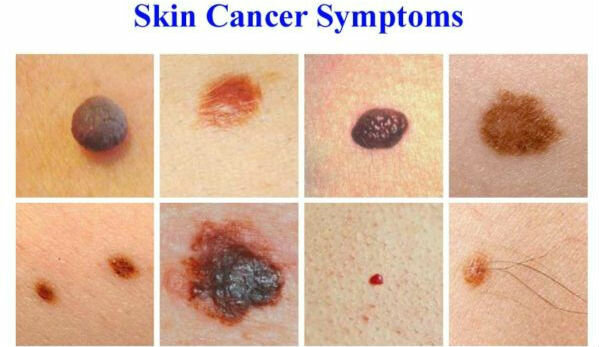 Simptomi ādas vēzi